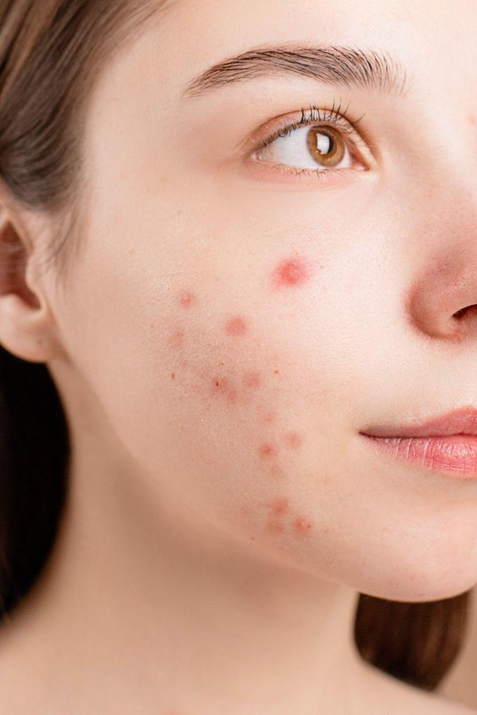 Woman in need of a virtual doctor consultation for acne
